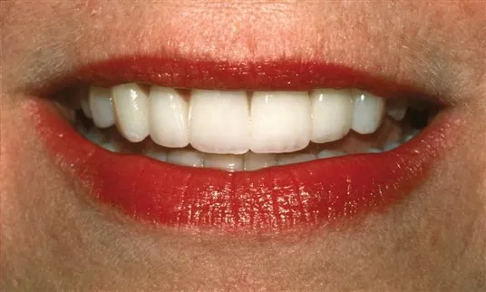 after veneers at Bellevue Dental Excellence