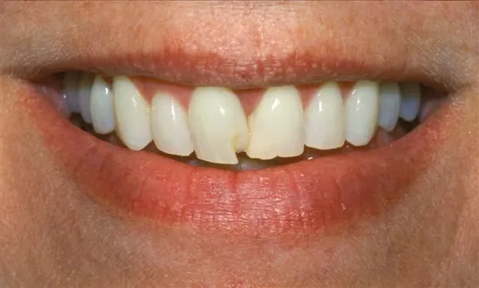 before veneers at Bellevue Dental Excellence