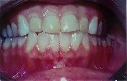 person's teeth before getting veneers Hilliard, OH cosmetic dentistry