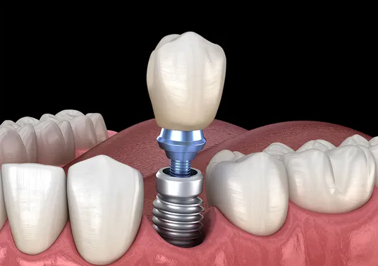 implant crown being attached onto Dental Implants Manteca, CA dentist