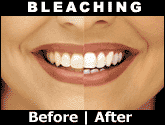 before and after image of teeth bleaching, teeth whitening Decatur, IL teeth bleaching