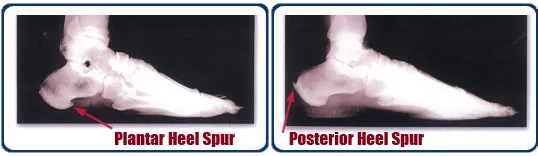 Types of heel pain