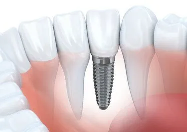 illustration of dental implant embedded in jaw with natural teeth, cosmetic dentistry Brookline, MA dental implants