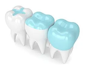 model of three teeth showing examples on teeth of filling, inlay, and onlay, cosmetic dentistry Brookline, MA dentist