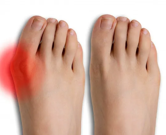 bunion pain in Winter Haven, Lakeland, & Davenport, FL