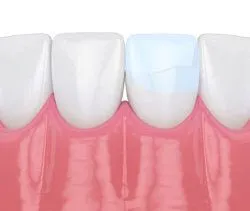 illustration of row of teeth, bonding repairing crack in one tooth, dental bonding Sachse, TX dentist