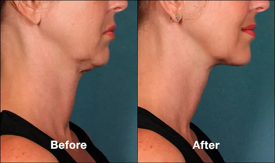 Kybella Before and After Female Treatment Photo