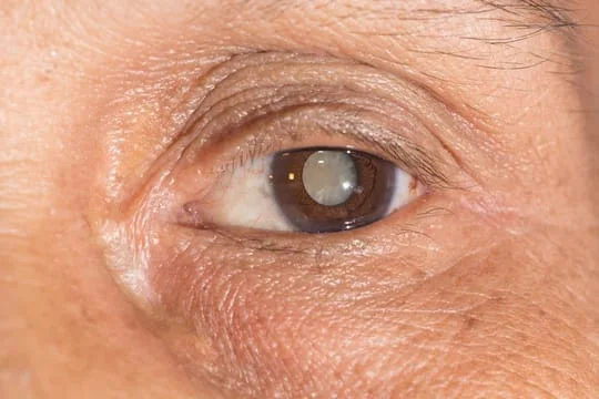 cataract-faqs