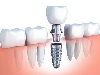 single dental implant being assembled and placed in between natural teeth, dentist Lawrenceville, GA dental implants