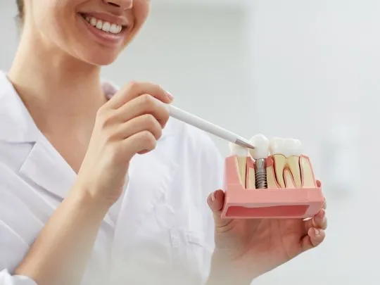 Dental Implant Model | Sterling Heights MI 
