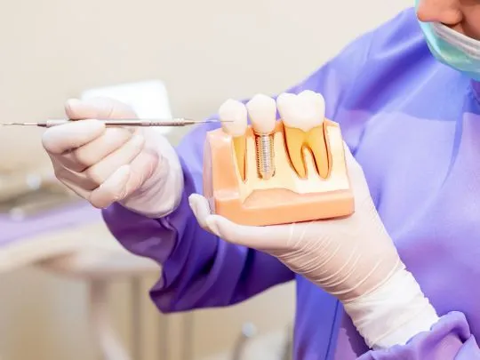 Dental Implants working model Macomb MI