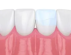 illustration of teeth, one tooth cracked being repaired with dental bonding, cosmetic dentistry Bradenton, FL dentist