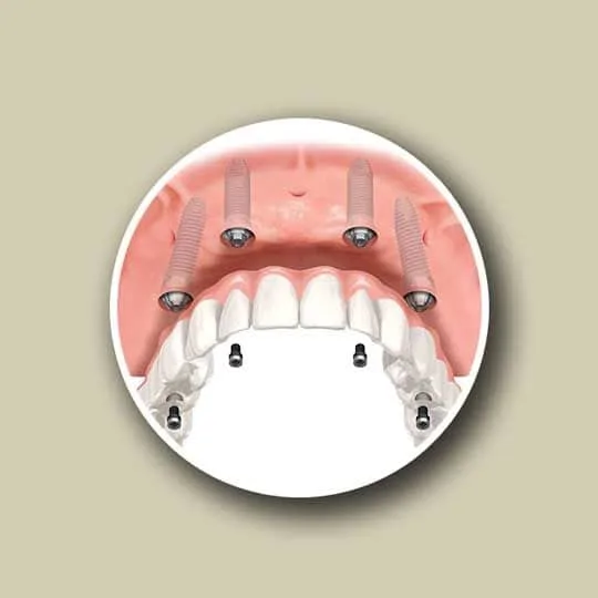 All on four dental implant procedure by Wisconsin Dental Solutions