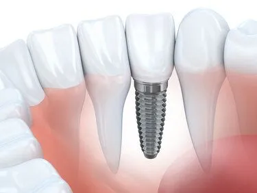 illustration of embedded dental implant next to natural teeth, dental implant restoration Alpharetta, GA and Acworth, GA dentist