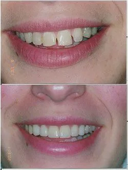 before and after image of woman's gapped uneven teeth enhanced with veneers Hauppauge, NY family dentist