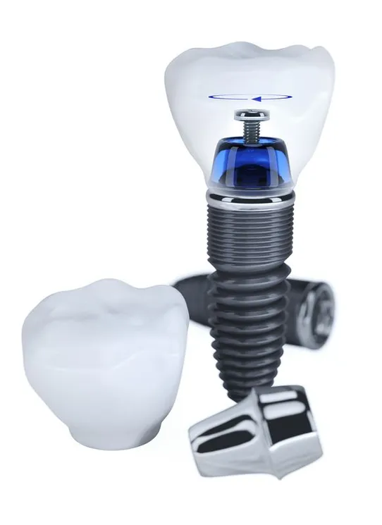 Dental Implant