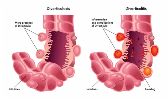 Diverticulitis Image