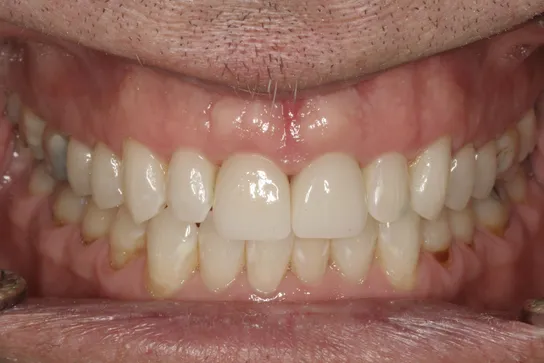 COSMETIC CROWN REPLACEMENT AFTER