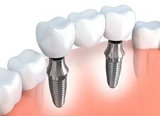 illustration of dental implant bridge replacing multiple teeth, dental implants Lincoln, NE dentist
