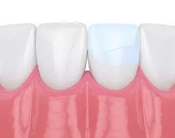 illustration of row of teeth, one tooth with bonding to repair crack, dental bonding Folsom, CA dentist