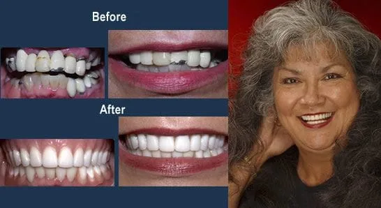 Alabama Dentist - Porcelain Crowns and a Partial Denture