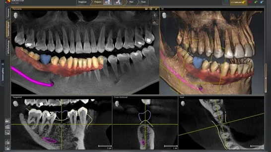 digital scan of person's mouth showing plan for dental implant placement, New Baltimore, MI dental implants