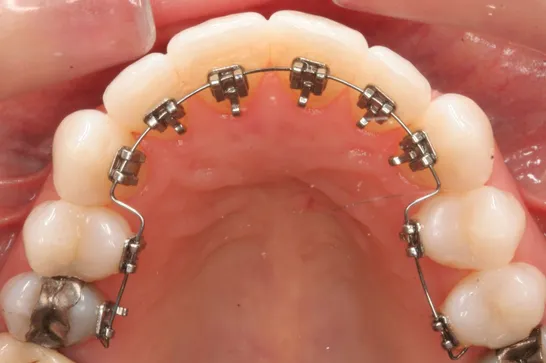 Lingual Braces.