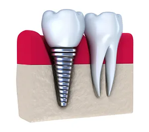 computer illustration of implant embedded in gum next to natural tooth, Dental Implants Narberth, PA