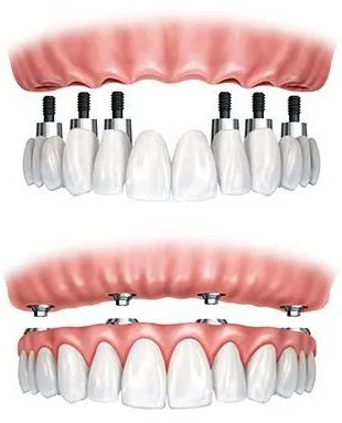 illustration showing dental implants replacing full arch of teeth and implants supporting removable dentures, Lincoln, NE implant dentistry