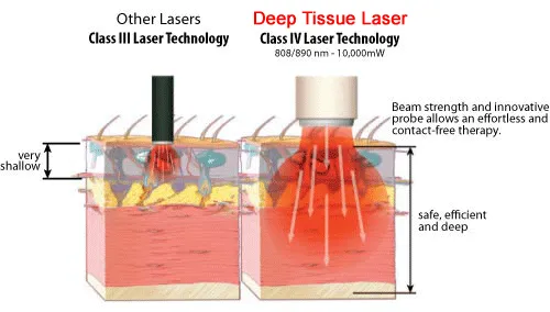 Lightforce class 4 sales laser