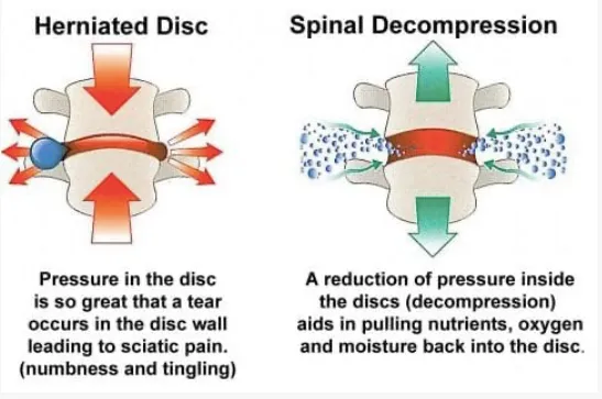 Spine Decompression Negative Pressure