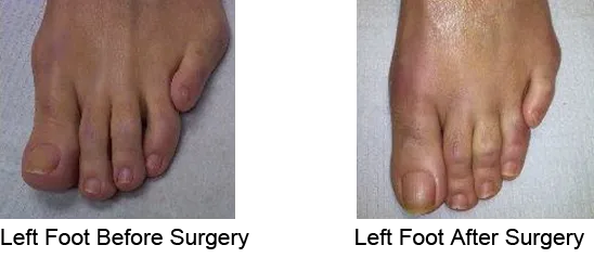 Bunion Before and After Photo Case 11