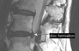 disc_lesions0004.jpg