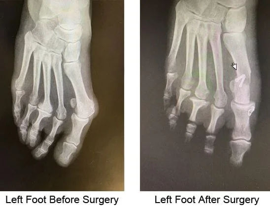Bunion Before and After Photo Case 0