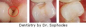 Cavity on side of tooth, direct resin restoration - Restorative Dentistry by Dr. Dean Sophocles