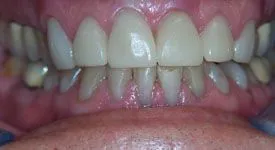 After Teeth Whitening