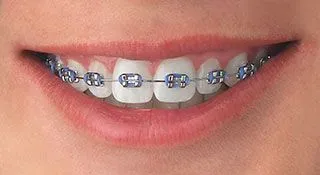 braces