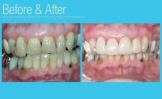 Before and After photos Milwaukee WI Dentist