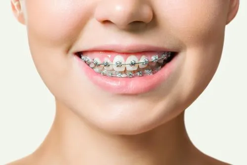 Metal Braces - Scarborough Orthodontics