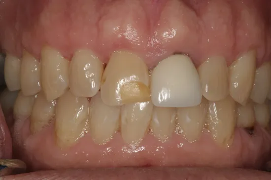 COSMETIC CROWN REPLACEMENT BEFORE