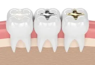 illustration of three teeth, each with a different type of dental filling, Narberth, PA general dentistry