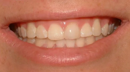 veneers_img11.jpg