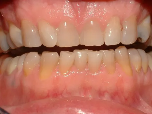 veneers_img2.jpg