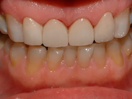 veneers_img21.jpg