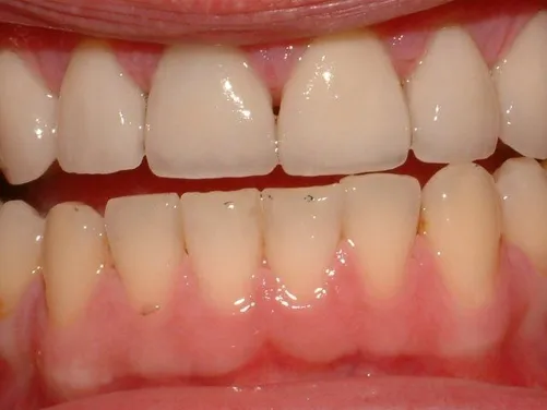 veneers_img3.JPG