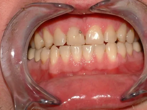 veneers_img31.JPG