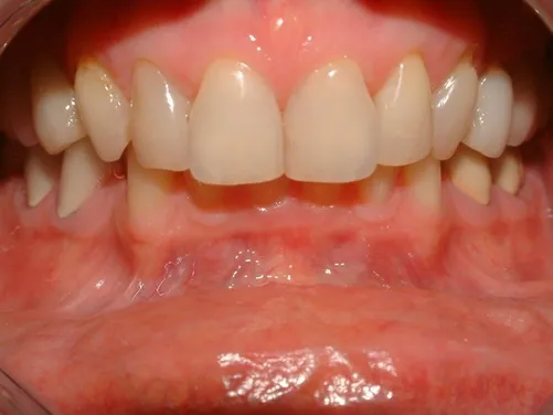 veneers_img41.JPG