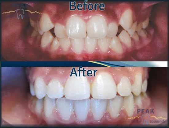 Ortho Before and After