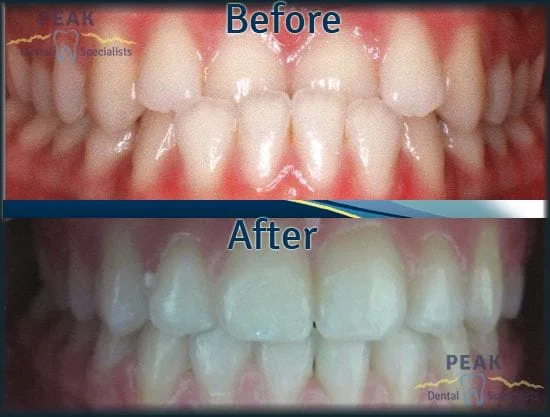 Ortho Before and After