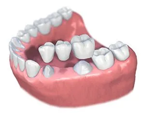 Dental bridge